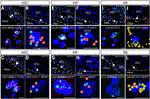 Identification of proliferating neural progenitors in the adult human hippocampus